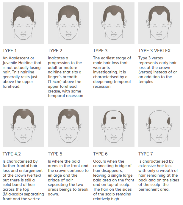 Types of Hair Loss - Essex Hair Clinic