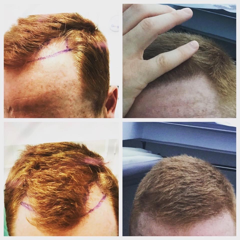 hair transplant results essex