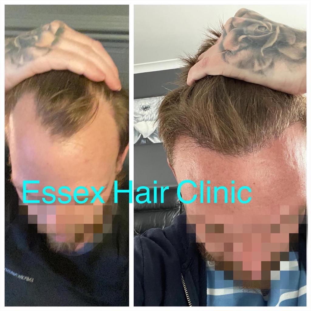hair transplant results uk