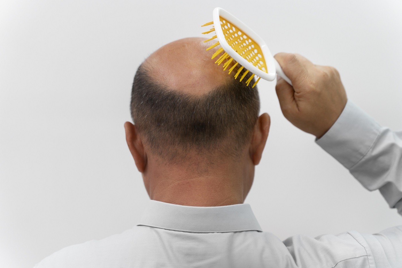 Most Common Skin Conditions Which May Cause Hair Loss Essex Hair Clinic