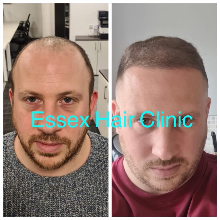 Hair Transplant Results | Essex Hair Clinic