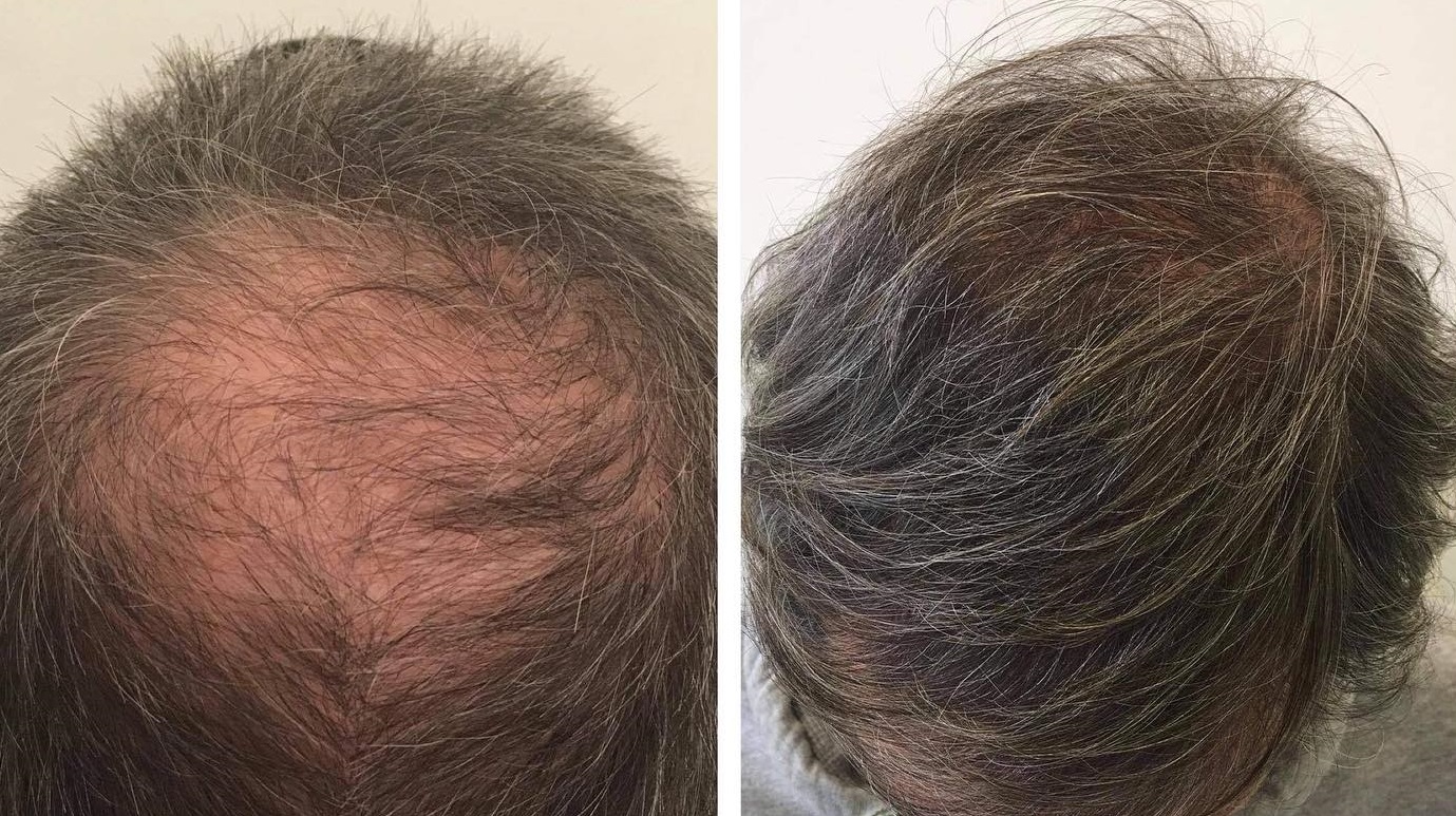Crown Hair Transplant - Yes or No - Essex Hair Clinic